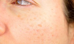 Cách hạn chế đồi mồi trên da