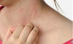 Nổi mề đay khi giao m&#249;a - L&#224;m sao trị dứt?