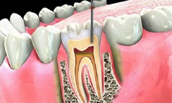 Khi n&#224;o cần điều trị vi&#234;m tủy răng?