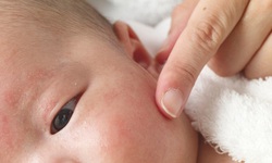 Cách khắc phục chàm tai