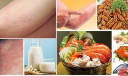 Ăn uống thế n&#224;o khi bị mề đay?