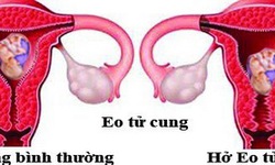 Bệnh dễ g&#226;y sẩy thai &#237;t người biết