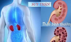 Bệnh suy thận mạn t&#237;nh, những điều n&#234;n biết