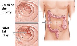 Polyp đại trực tr&#224;ng c&#243; th&#224;nh ung thư?