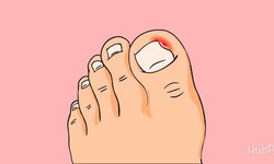 Móng quặp, chữa trị thế nào?