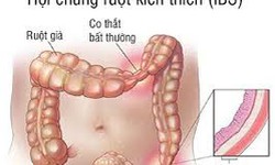 Nhận biết hội chứng ruột k&#237;ch th&#237;ch