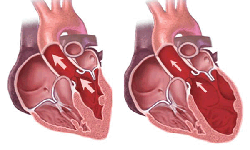 Ai dễ mắc bệnh thấp tim?