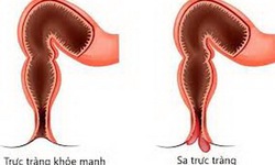 B&#224;i thuốc hay trị chứng sa trực tr&#224;ng