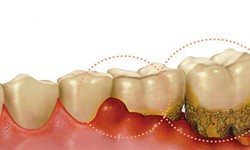 Vi&#234;m lợi c&#243; g&#226;y biến chứng?