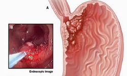 Dấu hiệu ung thư dạ d&#224;y giai đoạn sớm