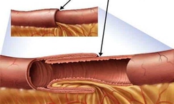 Người lớn cũng c&#243; thể bị lồng ruột