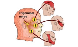 Các chất ức chế TNF có thể gây viêm thần kinh
