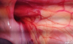 Cảnh giác với thoát vị bẹn ở trẻ em