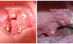 Yếu tố n&#224;o dẫn đến ung thư v&#242;m họng?