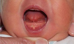 Nhận biết d&#237;nh thắng lưỡi ở trẻ nhỏ