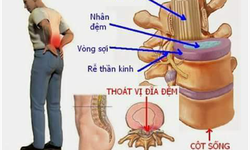 Thoát vị đĩa đệm cột sống thắt lưng chữa thế nào?