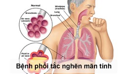 Ph&#242;ng ngừa nguy cơ cho người bệnh phổi tắc nghẽn mạn t&#237;nh trong đại dịch