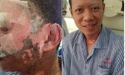 Bị bỏng nặng do nổ lò luyện gang, bệnh nhân được chữa khỏi bằng oxy cao áp