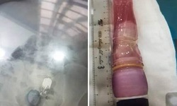 3 ngày không đại tiện cả bác sĩ và bệnh nhân choáng vì “dị vật” khủng trong hậu môn