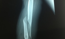 Thanh niên 19 tuổi gãy xương do chơi trò vật tay