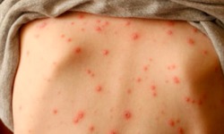 C&#225;ch ph&#225;t hiện bệnh thủy đậu
