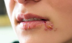 4 hướng mới điều trị Herpes trong tương lai