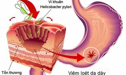 Nhiễm HP bao tử l&#224; g&#236;?