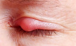 Lẹo mắt xử l&#253; thế n&#224;o cho đ&#250;ng?