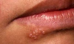 Bệnh do virut Herpes: Chữa trị thế n&#224;o?