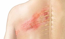 Đau do zona điều trị như thế n&#224;o?
