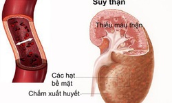 Ph&#242;ng ngừa v&#224; điều trị bệnh lao thận hiệu quả