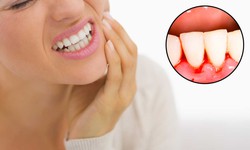 Cảnh b&#225;o khi bạn bị chảy m&#225;u ch&#226;n răng