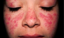 Bệnh lupus ban đỏ
