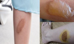 Bỏng bô xe làm thế nào để không bị sẹo