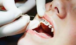 Khớp cắn ngược: &#208;iều trị c&#224;ng sớm c&#224;ng tốt