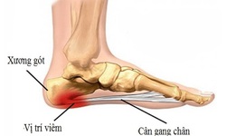 Xử tr&#237; vi&#234;m c&#226;n gan ch&#226;n kh&#244;ng phẫu thuật