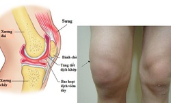 Vi&#234;m điểm b&#225;m g&#226;n v&#224; tr&#224;n dịch khớp c&#243; nguy hiểm?