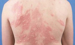B&#224;i thuốc chữa chứng mề đay