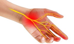 Chữa trị hội chứng ống cổ tay thế n&#224;o?