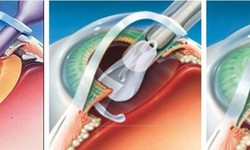 K&#237;nh nội nh&#227;n - Lựa chọn n&#224;o khi phẫu thuật phaco ?