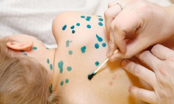 C&#225;ch ph&#242;ng v&#224; chăm s&#243;c người bệnh thủy đậu