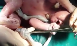 Video cận cảnh em b&#233; bị d&#226;y rau thắt n&#250;t ch&#224;o đời khỏe mạnh