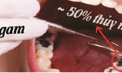 Amalgam – loại vật liệu h&#224;n răng chứa Thủy ng&#226;n cần được loại bỏ