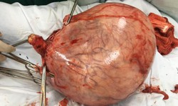 Bụng to bất thường kh&#244;ng chịu đi kh&#225;m, người phụ nữ mang khối u tử cung gần 5kg