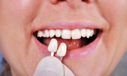 B&#225;c sĩ nha khoa cảnh b&#225;o tr&#224;o lưu gắn răng khểnh tiềm ẩn nhiều độc hại