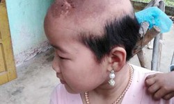 Số phận đ&#225;ng thương của b&#233; g&#225;i 3 lần phẫu thuật u n&#227;o &#225;c t&#237;nh