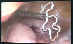 Đau bụng, vòng tránh thai 30 năm lạc chỗ trong ổ bụng cụ bà 63 tuổi