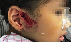 H&#224; Nội: Ch&#243; nh&#224; b&#224; ngoại cắn r&#225;ch mặt, tay b&#233; trai dịp nghỉ lễ