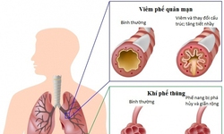 Hỗ trợ trị hen phế quản, hen suyễn, COPD theo đ&#244;ng y gia truyền 500 năm