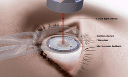 Điều cần biết khi phẫu thuật mắt bằng phương ph&#225;p LASIK